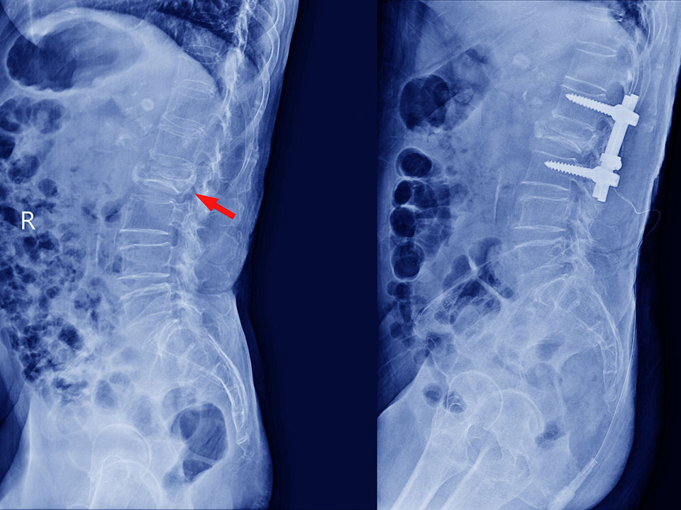 spine procedures decompression